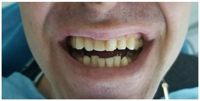 Before-